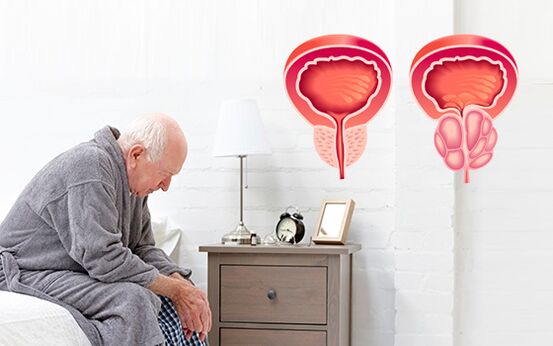 простатит при мъж